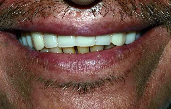 Dentures after photo
