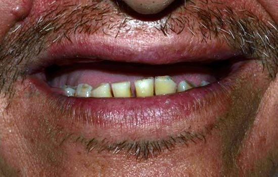 dentures before photo