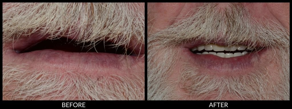 dentures before and after photo