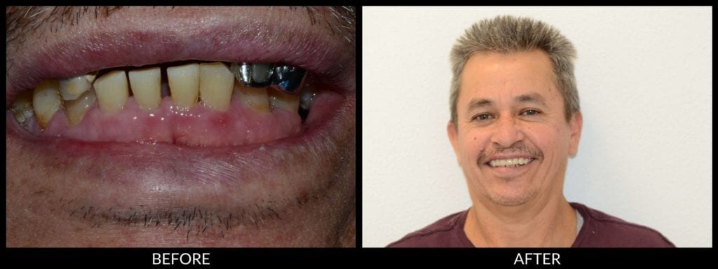 dentures before and after photo