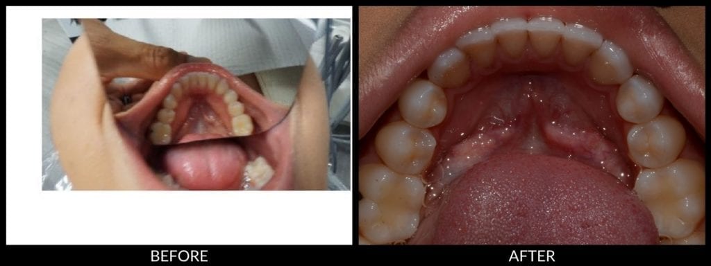 Invisalign before and after photo