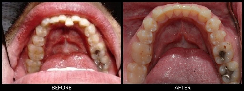 Invisalign before and after photo