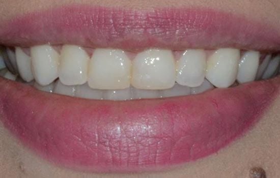 crown lengthening after photo
