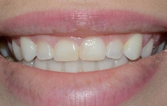 crown lengthening before photo