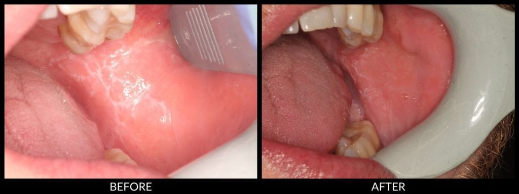 oral cancer exam before and after photo