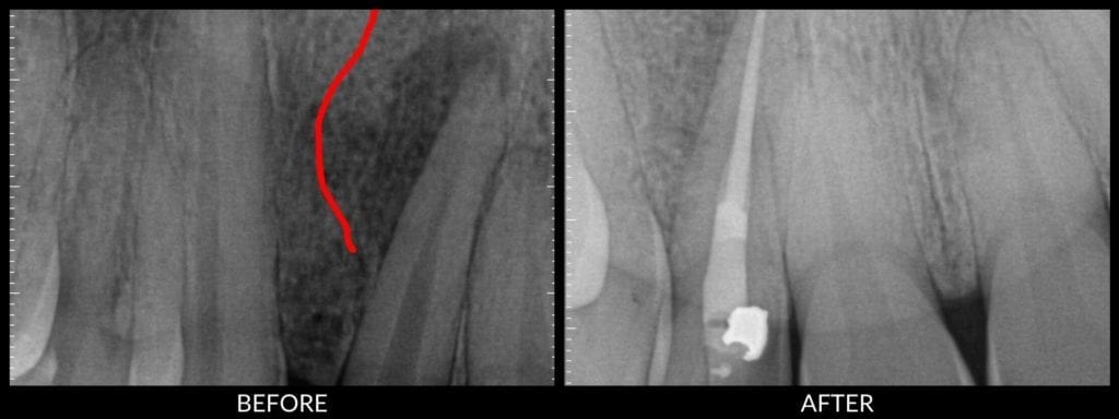 root canal therapy before and after xray