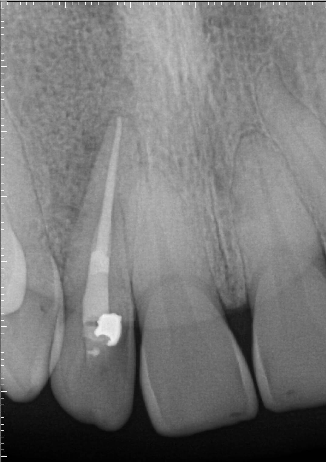 root canal after xray