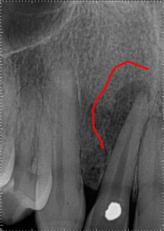 root canal before xray
