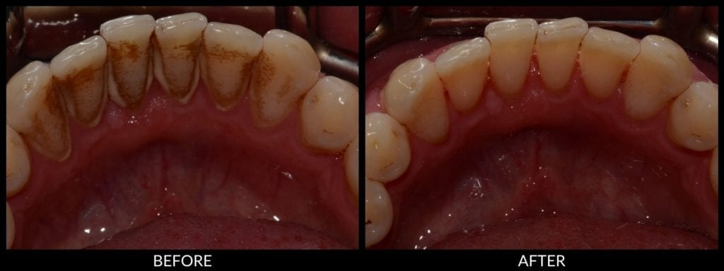 scaling and root planing before and after photo