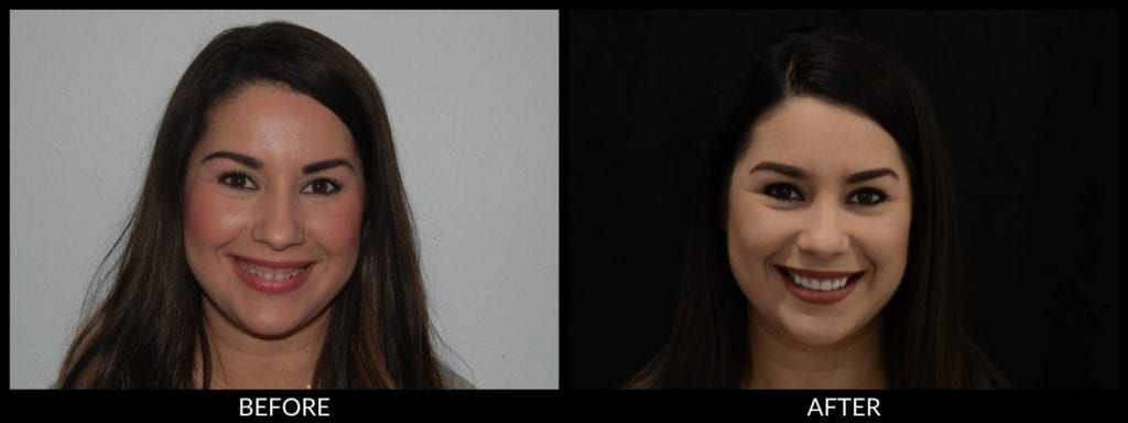 smile makeover before and after photo