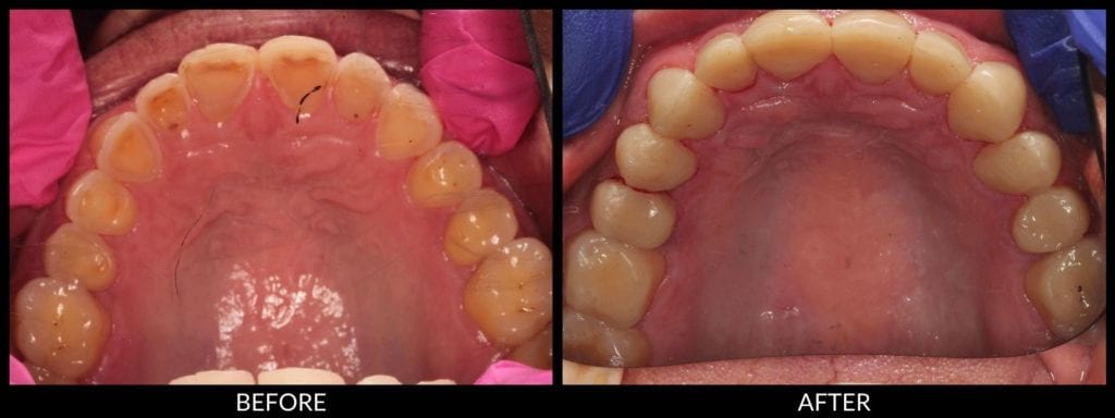 smile makeover before and after photo