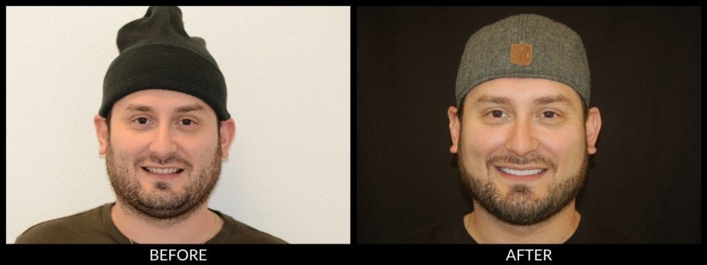 smile makeover before and after photo