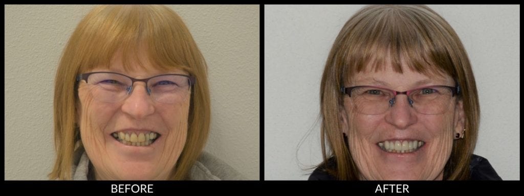 smile makeover before and after photo