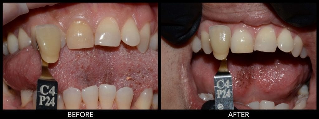 teeth whitening before and after photo