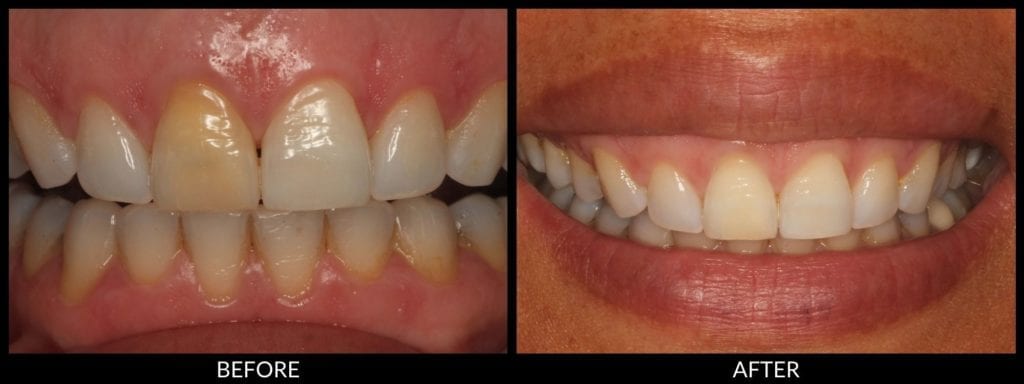 teeth whitening before and after photo