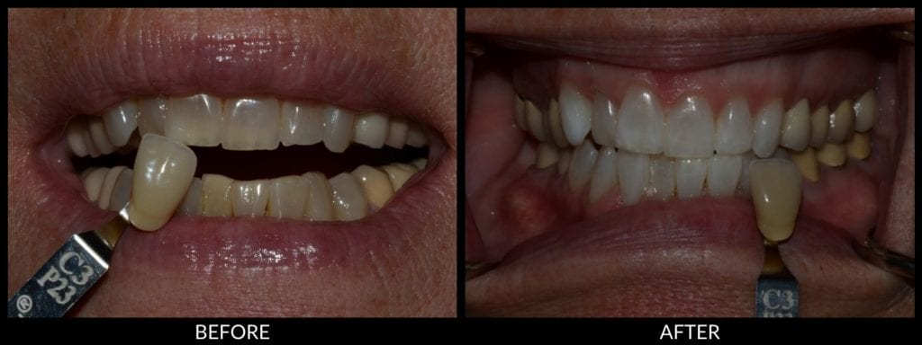 teeth whitening before and after photo