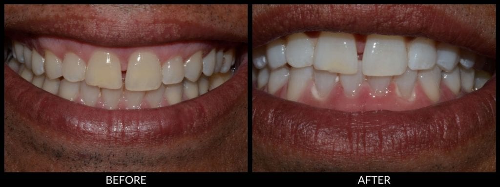teeth whitening before and after photo