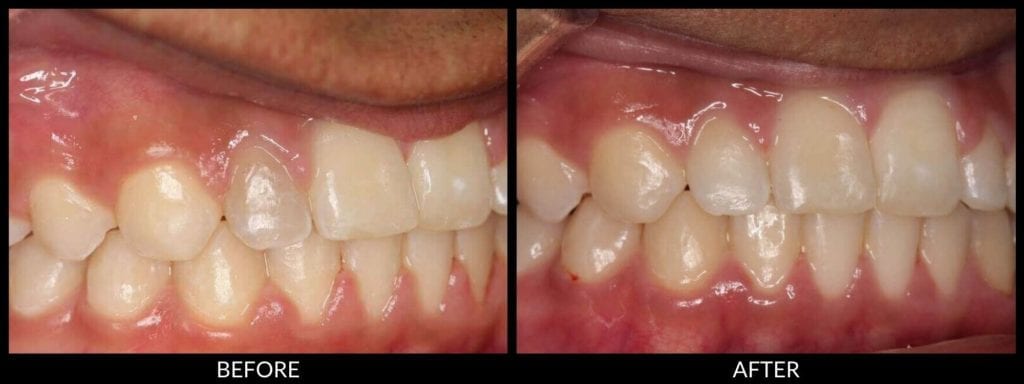 teeth whitening before and after photo
