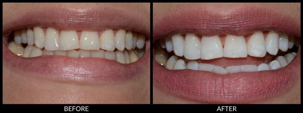 teeth whitening before and after photo