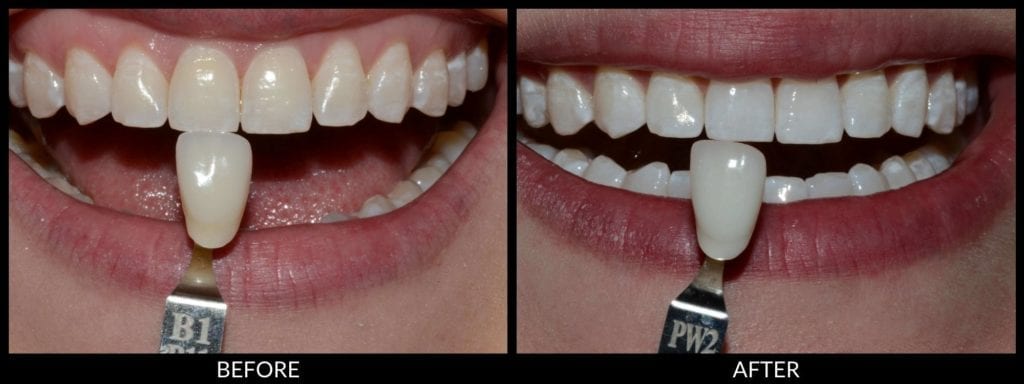 teeth whitening before and after photo