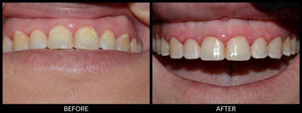 tooth colored fillings before and after photo
