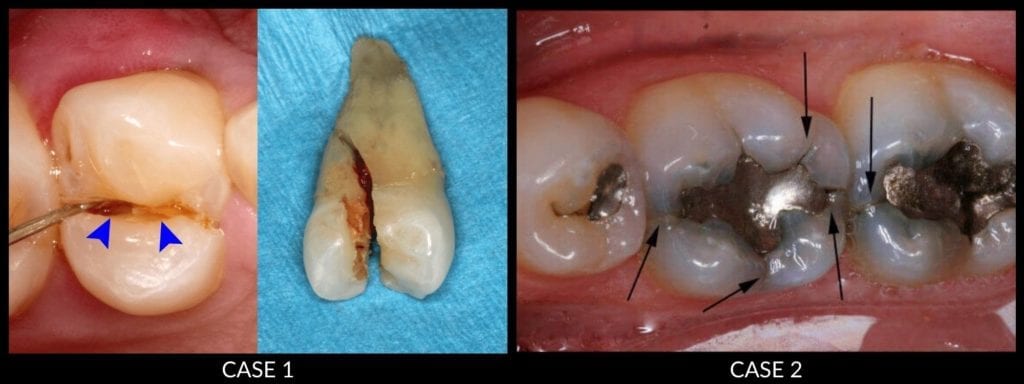 tooth extraction before and after photo