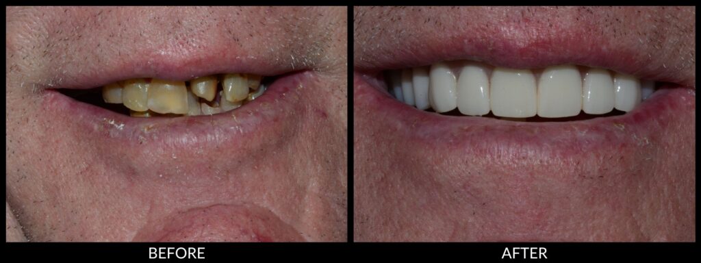 Copy of Veneers 2000x750 (1)