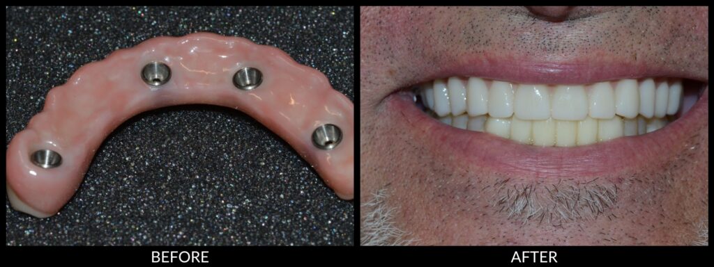 Copy of Veneers 2000x750 (2)