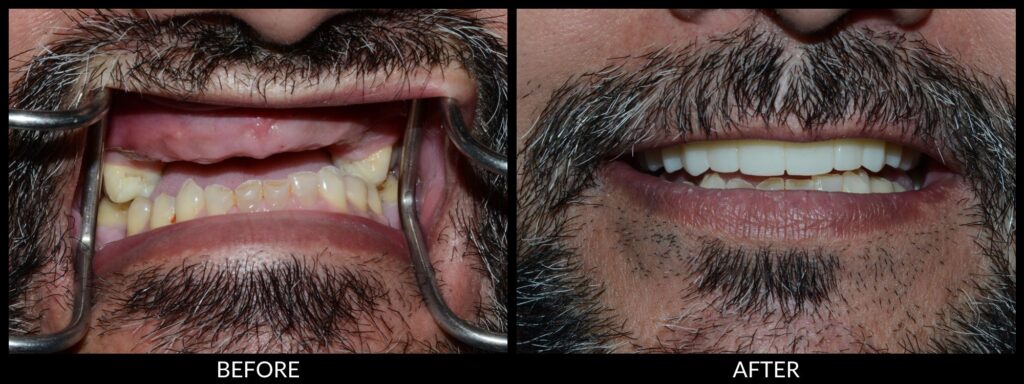 Copy of Veneers 2000x750 (4)