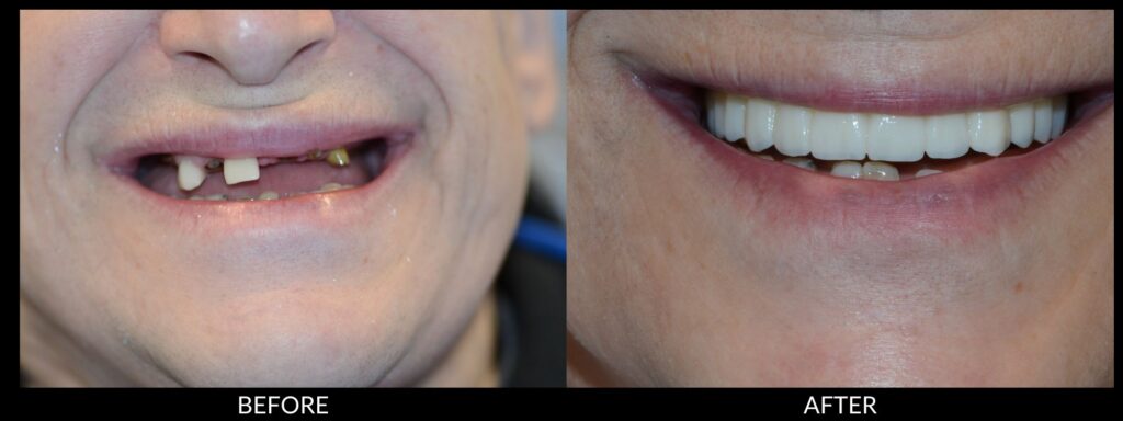 Copy of Veneers 2000x750 (5)